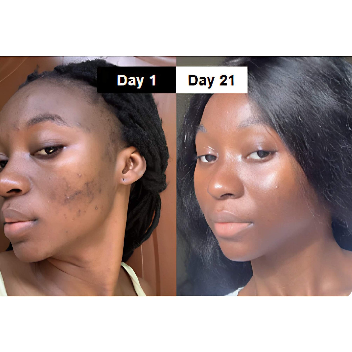 Clear Pores & Smooth Skin — Visible Results in 30 Days